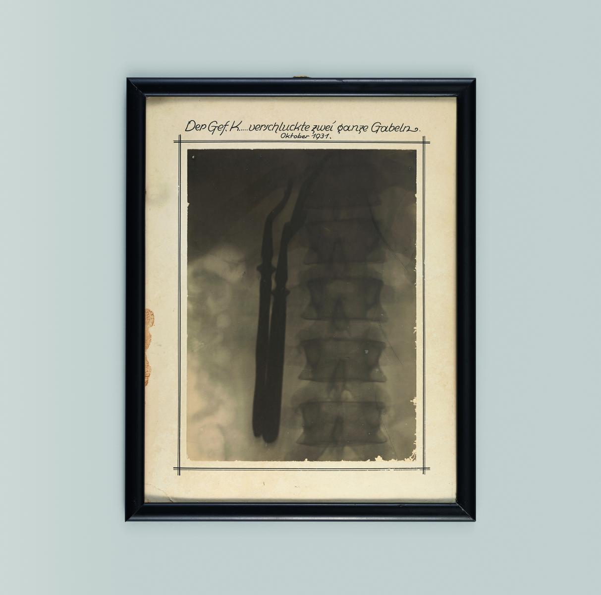 Bild einer eingerahmten Röntgenaufnahme, auf der die Wirbelsäule eines Gefangenen und daneben zwei sich dunkel abzeichnende Gabeln zu sehen sind, dazu die Überschrift "Der Gefangene K. verschluckte zwei ganze Gabeln, Oktober 1931"